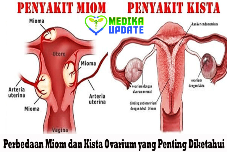 Perbedaan Miom dan Kista Ovarium yang Penting Diketahui